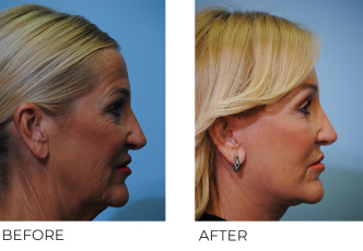 55-64 year old woman treated with Facelift 6 weeks ago