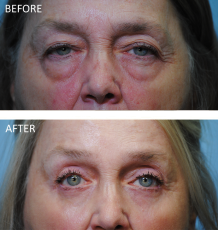 65-74 year old woman treated with Browlift 6 months ago