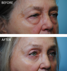 65-74 year old woman treated with Browlift 6 months ago B