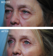 65-74 year old woman treated with Browlift 6 months ago