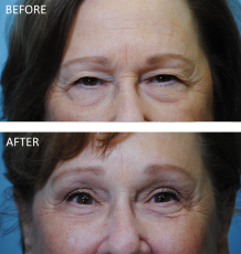 75 and over patient treated with Browlift 3 months ago