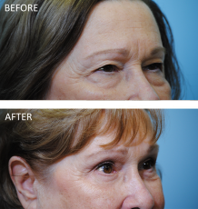 75 and over patient treated with Browlift 3 months ago