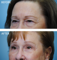 75 and over patient treated with Browlift 3 months ago