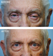 76-84 year old man treated with Ptosis Repair 6 months ago