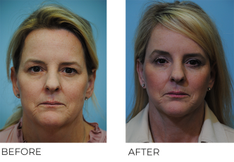 45-54 year old woman treated with Facelift 2 years ago