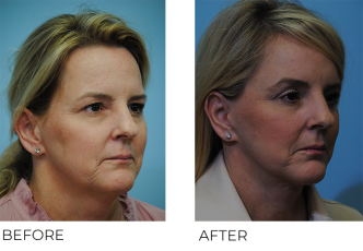 45-54 year old woman treated with Facelift 2 years ago