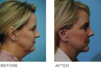 45-54 year old woman treated with Facelift 2 years ago
