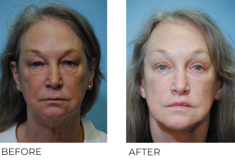 65-74 year old woman treated with Facelift 1 month ago