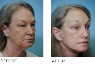 65-74 year old woman treated with Facelift 1 month ago