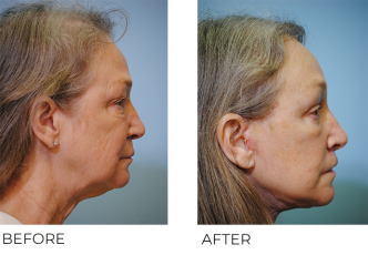 65-74 year old woman treated with Facelift 1 month ago