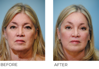 65-74 year old woman treated with Facelift 2 years ago