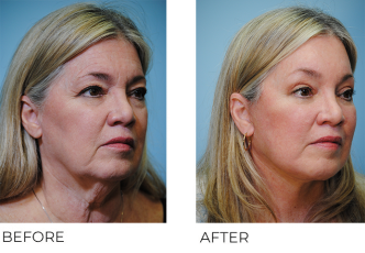 65-74 year old woman treated with Facelift 2 years ago B