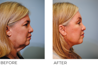 65-74 year old woman treated with Facelift 2 years ago