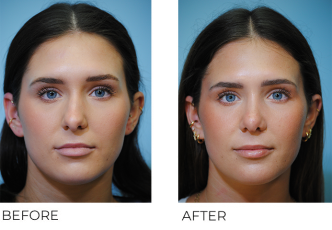 18-24 year old woman treated with Rhinoplasty 1 month ago