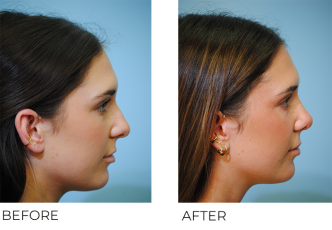 18-24 year old woman treated with Rhinoplasty 1 month ago