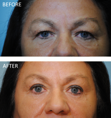 55-64 year old woman treated with Browlift 1 year ago