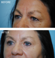 55-64 year old woman treated with Browlift 1 year ago