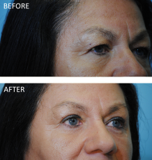 55-64 year old woman treated with Browlift 1 year ago