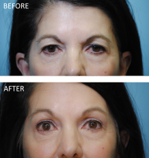 65-74 year old woman treated with Browlift 2 months ago