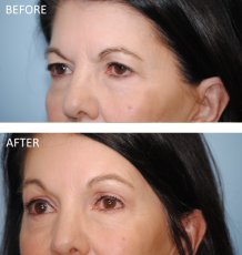65-74 year old woman treated with Browlift 2 months ago
