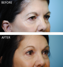 65-74 year old woman treated with Browlift 2 months ago