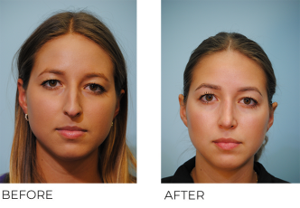 18-24 year old woman treated with Rhinoplasty 6 months ago