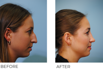 18-24 year old woman treated with Rhinoplasty 6 months ago