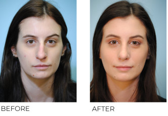 25-34 year old woman treated with Rhinoplasty 6 months ago