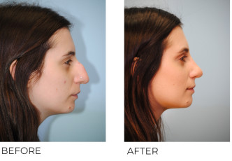 25-34 year old woman treated with Rhinoplasty 6 months ago