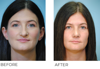 35-44 year old woman treated with Rhinoplasty 6 weeks ago