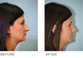 35-44 year old woman treated with Rhinoplasty 6 weeks ago