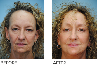 55-64 year old woman treated with Facelift 1 month ago