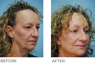 55-64 year old woman treated with Facelift 1 month ago