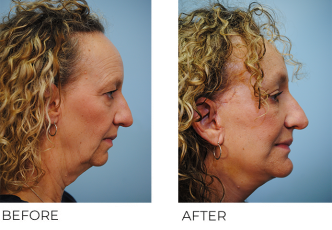55-64 year old woman treated with Facelift 1 month ago