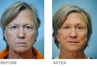 55-64 year old woman treated with Facelift 6 months ago