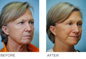 55-64 year old woman treated with Facelift 6 months ago