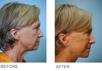 55-64 year old woman treated with Facelift 6 months ago