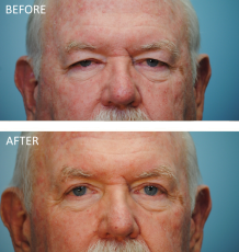 65-74 year old man treated with Browlift and Blephs 3 months postop
