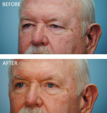 65-74 year old man treated with Browlift and Blephs 3 months postop