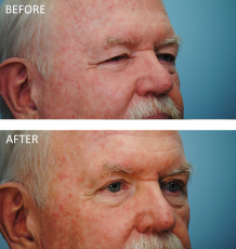 65-74 year old man treated with Browlift and Blephs 3 months postop