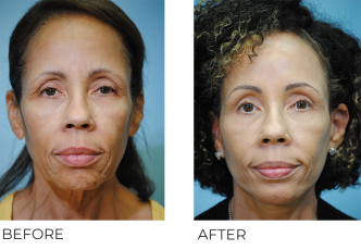 65-74 year old woman treated with Facelift 3 months ago