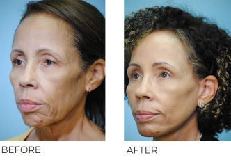 65-74 year old woman treated with Facelift 3 months ago