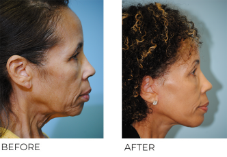 65-74 year old woman treated with Facelift 3 months ago