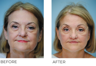 65-74 year old woman treated with Facelift 6 weeks ago