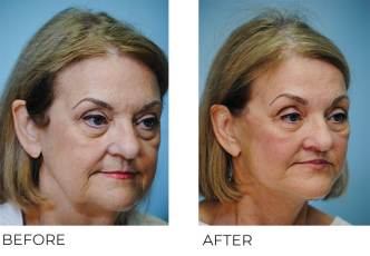 65-74 year old woman treated with Facelift 6 weeks ago