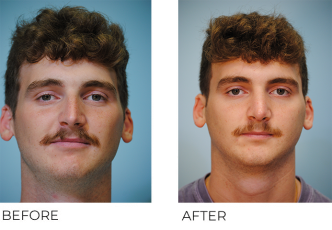 18-24 year old man treated with Rhinoplasty 1 month postop