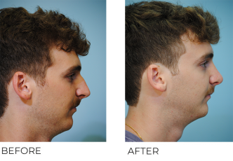 18-24 year old man treated with Rhinoplasty 1 month postop
