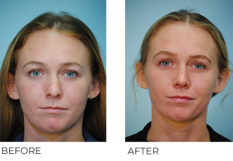 18-24 year old woman treated with Rhinoplasty 2 months ago