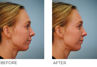 18-24 year old woman treated with Rhinoplasty 2 months ago