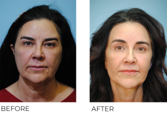 55-64 year old woman treated with Facelift 1 year ago